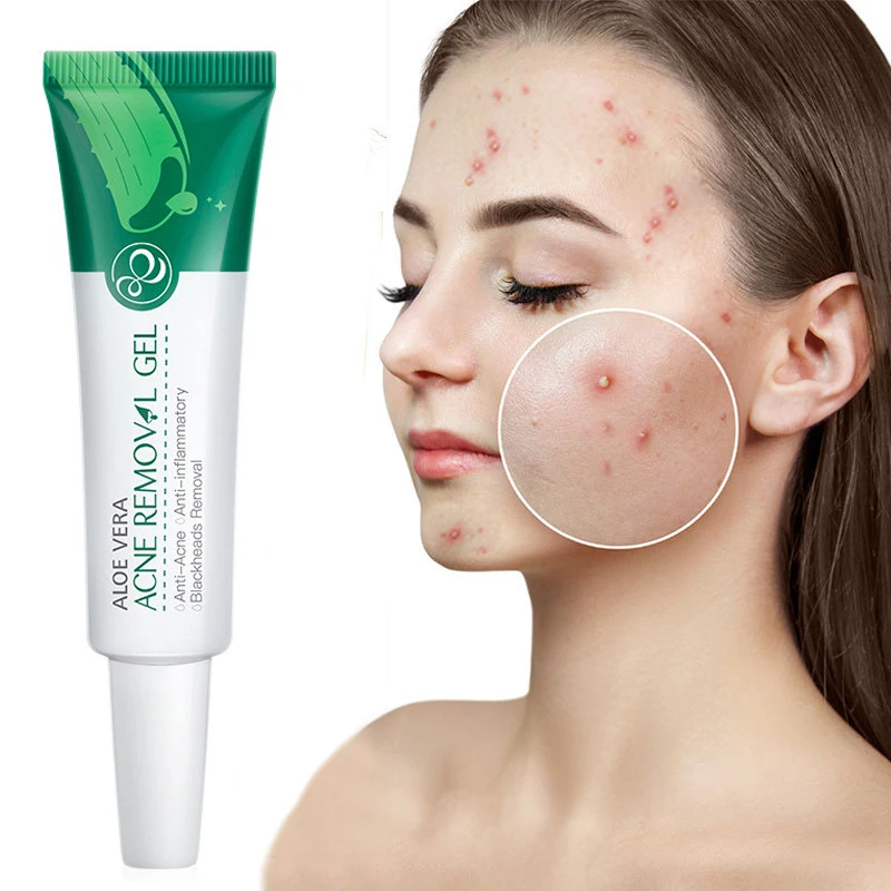 Solutii pentru cicatricile post acnee | Sfaturi cosmetice