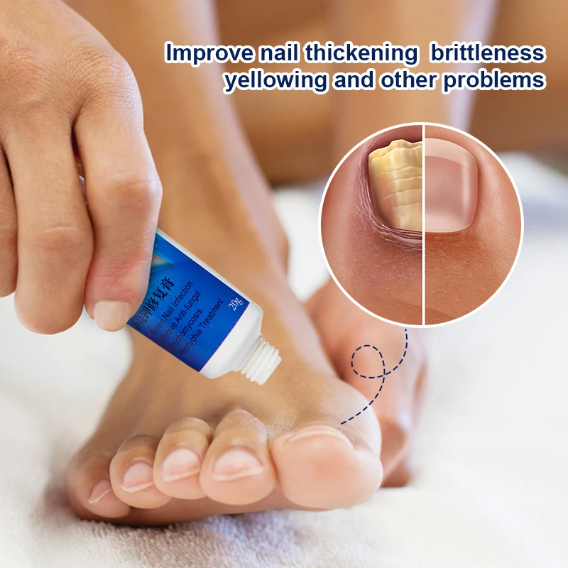 curăță picioarele de ciuperca unghiilor iodinol din băile de ciuperci ale unghiilor de la picioare